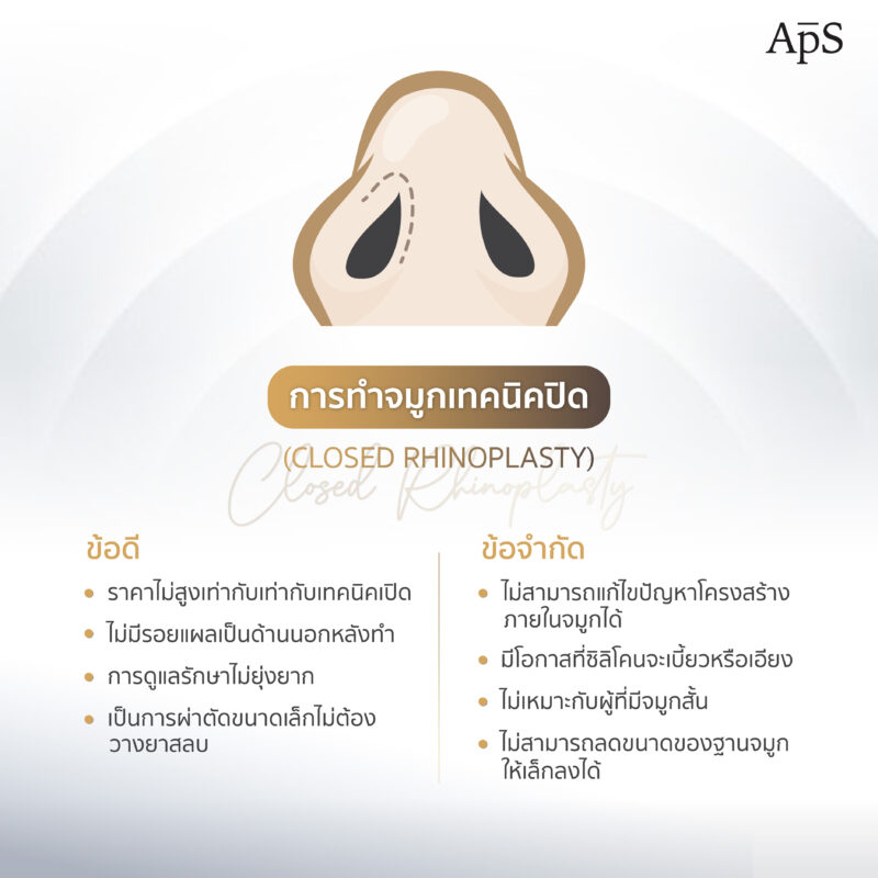 ทำจมูกเทคนิคปิด (Closed Rhinoplasty) เทคนิคเสริมจมูกยอดนิยมที่ทำกันมานาน 2 ข้อดี และข้อจำกัดของทำจมูกเทคนิคปิด