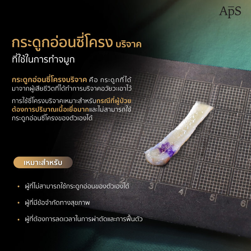 ข้อดีของกระดูกอ่อนซี่โครงบริจาค