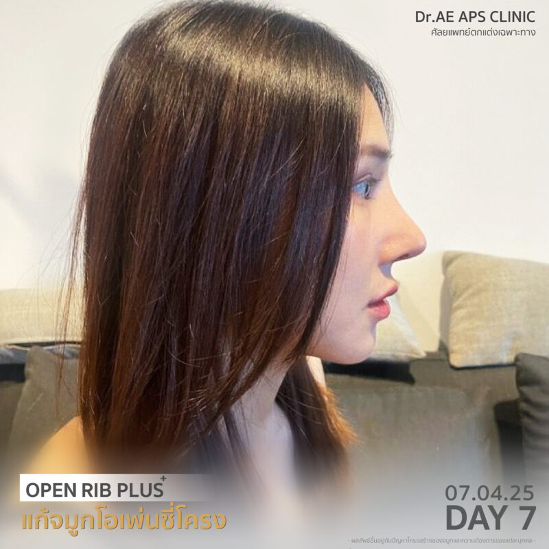 รีวิวแก้จมูกรอบ 4 ด้วยเทคนิคโอเพ่นซี่โครงสวยงง จนแทบจำตัวเองไม่ได้ เป๊ะสุดใน 7 วัน! โดยคุณป๊อบ 5 รีวิวแก้จมูกรอบ 4 ป๊อบอาย
