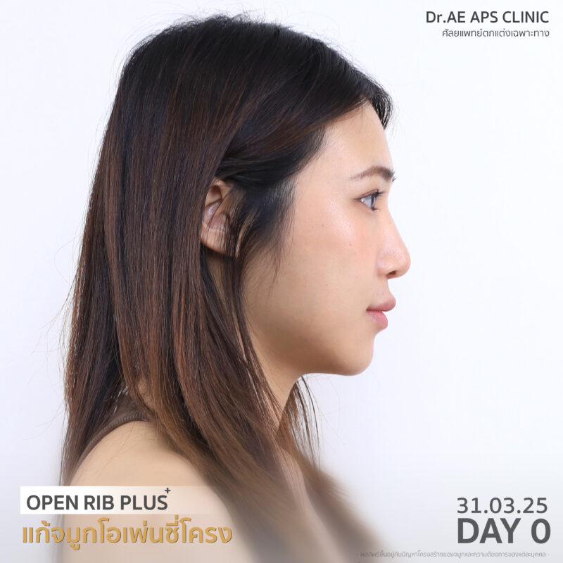 รีวิวแก้จมูกรอบ 4 ด้วยเทคนิคโอเพ่นซี่โครงสวยงง จนแทบจำตัวเองไม่ได้ เป๊ะสุดใน 7 วัน! โดยคุณป๊อบ 3 รีวิวแก้จมูกรอบ 4 ป๊อบอาย