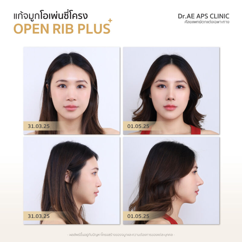 รีวิวแก้จมูกรอบ 4 ด้วยเทคนิคโอเพ่นซี่โครงสวยงง จนแทบจำตัวเองไม่ได้ เป๊ะสุดใน 7 วัน! โดยคุณป๊อบ 2 รีวิวแก้จมูกรอบ 4 ป๊อบอาย
