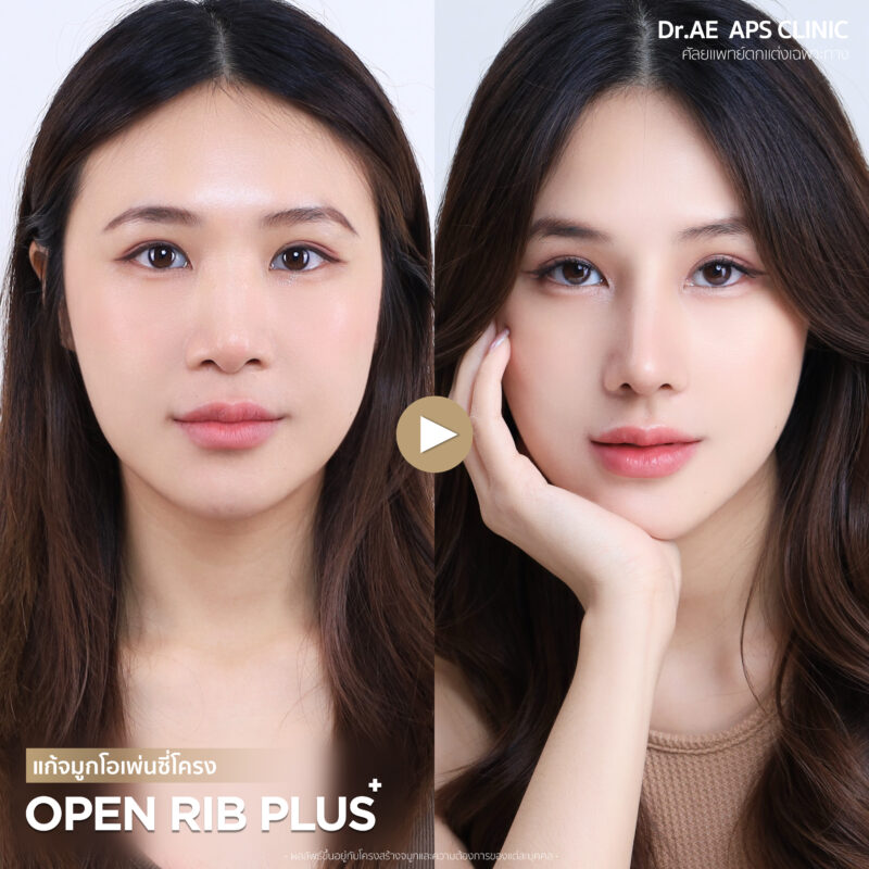 รีวิวแก้จมูกรอบ 4 ด้วยเทคนิคโอเพ่นซี่โครงสวยงง จนแทบจำตัวเองไม่ได้ เป๊ะสุดใน 7 วัน! โดยคุณป๊อบ 6 รีวิวแก้จมูกรอบ 4 ป๊อบอาย