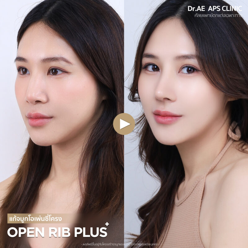 รีวิวแก้จมูกรอบ 4 ด้วยเทคนิคโอเพ่นซี่โครงสวยงง จนแทบจำตัวเองไม่ได้ เป๊ะสุดใน 7 วัน! โดยคุณป๊อบ 7 รีวิวแก้จมูกรอบ 4 ป๊อบอาย