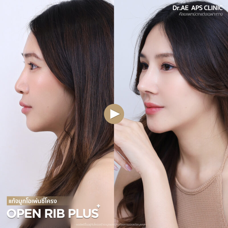 รีวิวแก้จมูกรอบ 4 ด้วยเทคนิคโอเพ่นซี่โครงสวยงง จนแทบจำตัวเองไม่ได้ เป๊ะสุดใน 7 วัน! โดยคุณป๊อบ 8 รีวิวแก้จมูกรอบ 4 ป๊อบอาย