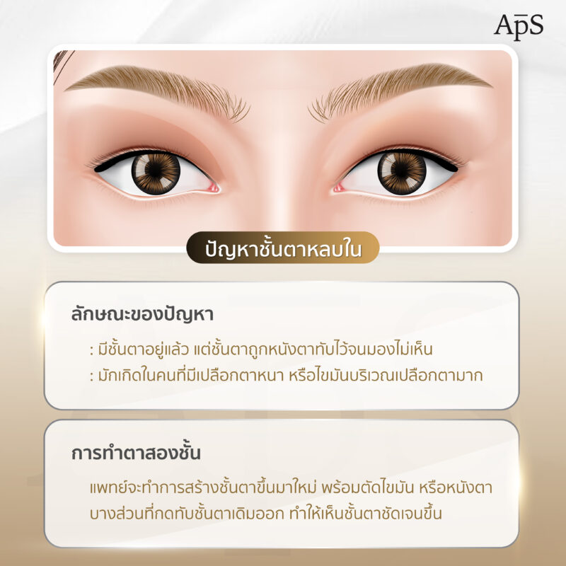 ปัญหาตาหลบใน (Hidden Eyelid / Partially Hooded Eyelid)