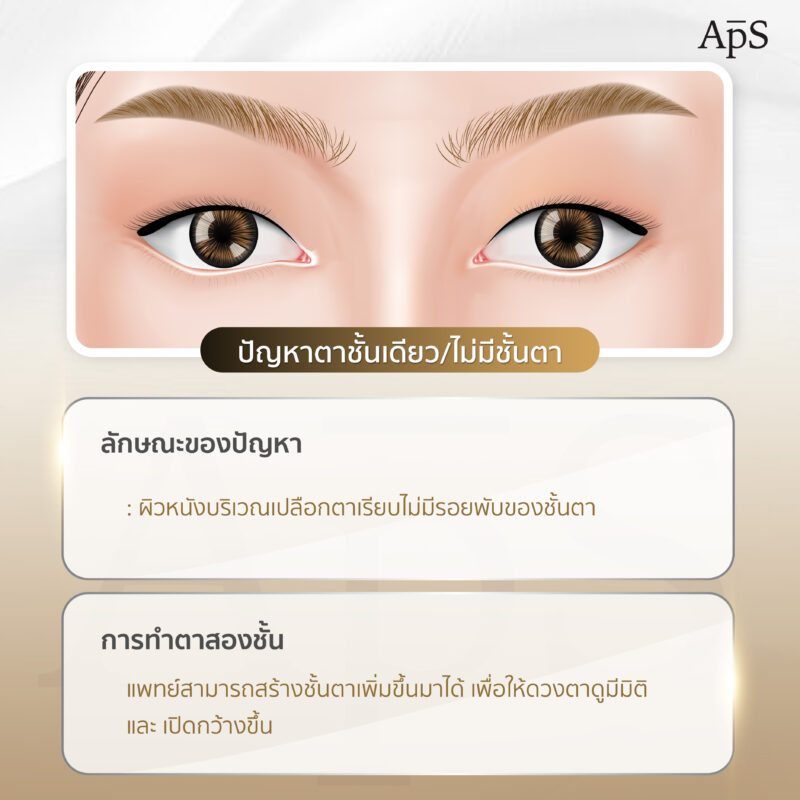 ปัญหาตาชั้นเดียว (Monolid)