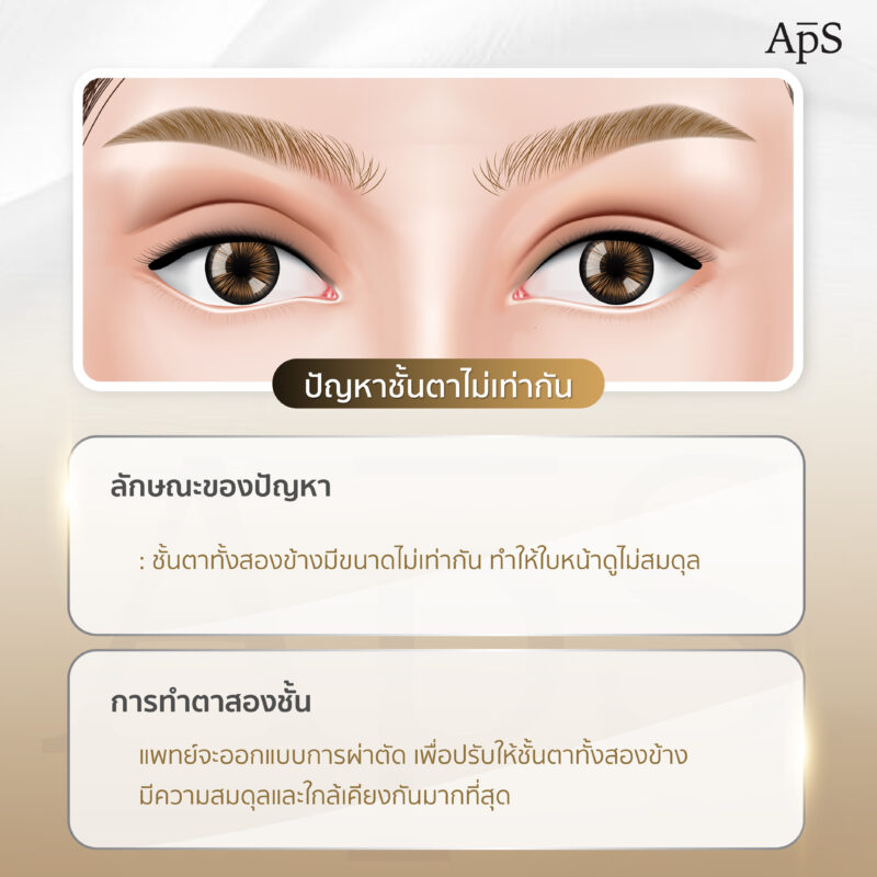 ปัญหาชั้นตาไม่เท่ากัน (Asymmetrical Eyelids)