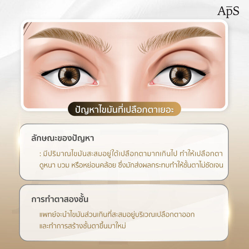ปัญหาไขมันสะสมบริเวณเปลือกตามากเกินไป (Excess Fat in Eyelids)