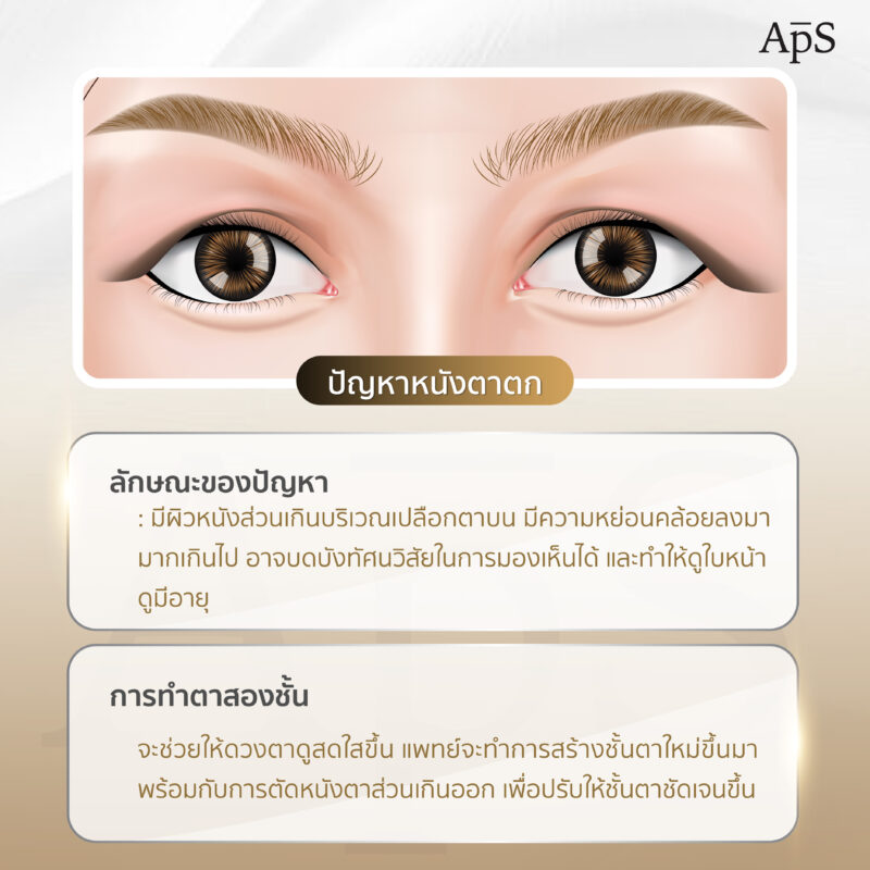 ปัญหาเปลือกตาตก / หนังตาตก (Ptosis / Droopy Eyelids)