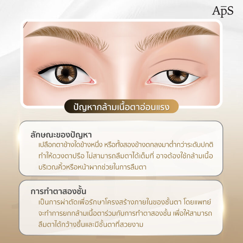 ปัญหากล้ามเนื้อตาอ่อนแรง