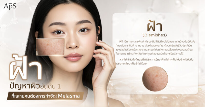 รักษาฝ้า