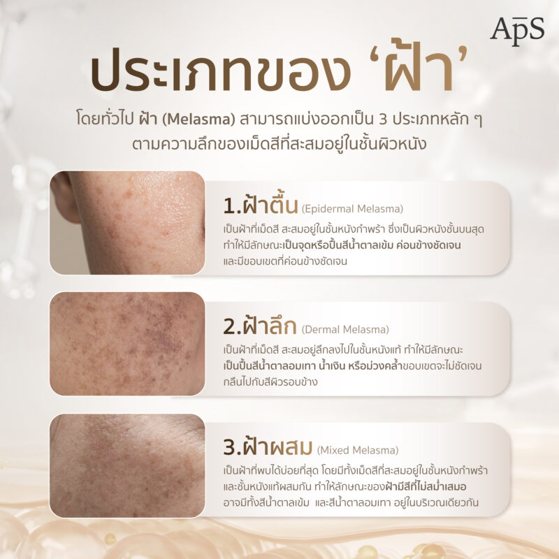 ฝ้าคืออะไร เกิดได้ยังไง ป้องกัน และรักษาด้วยวิธีไหนจึงจะได้ผลดี 4 ฝ้า ถูกแบ่งออกเป็น 3 ประเภท