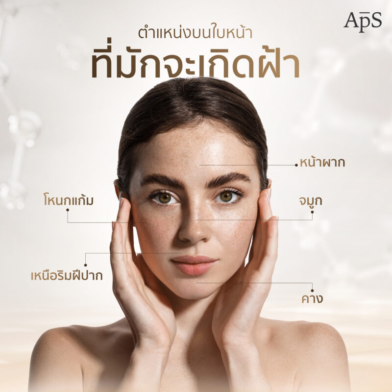 ฝ้าคืออะไร เกิดได้ยังไง ป้องกัน และรักษาด้วยวิธีไหนจึงจะได้ผลดี 2 บริเวณที่มักจะเกิดฝ้า