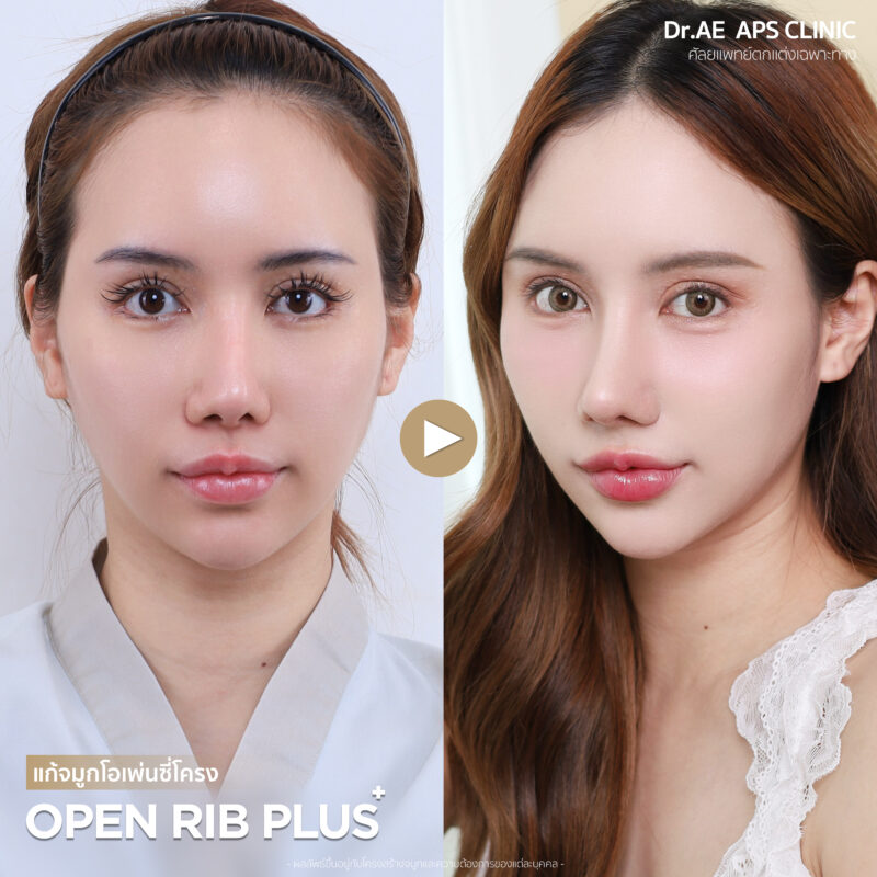 แก้จมูกที่ APS Clinic ถูกใจกว่าทำที่เกาหลี รีวิวคุณกุ๊กไก่ 2 รีวิวคุณกุ๊กไก่