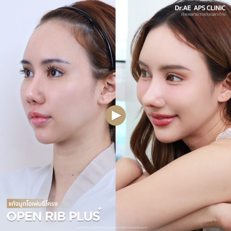 แก้จมูกที่ APS Clinic ถูกใจกว่าทำที่เกาหลี รีวิวคุณกุ๊กไก่ 3 รีวิวคุณกุ๊กไก่