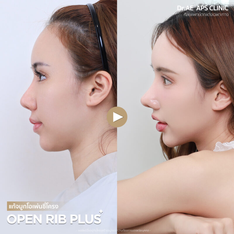 แก้จมูกที่ APS Clinic ถูกใจกว่าทำที่เกาหลี รีวิวคุณกุ๊กไก่ 4 รีวิวคุณกุ๊กไก่