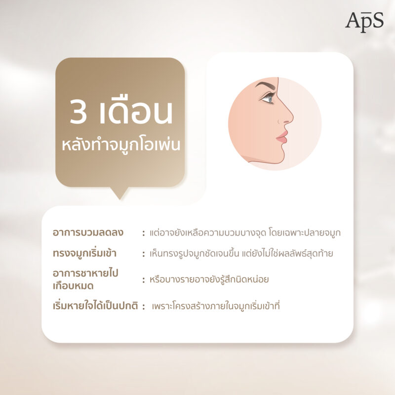 อาการหลังทำศัลยกรรมเสริมจมูกโอเพ่น เป็นอย่างไร อันตรายไหม 8 3 เดือนหลังการเสริมจมูกโอเพ่น