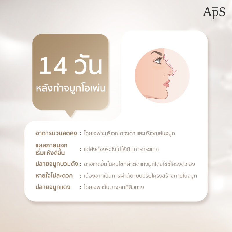 อาการหลังทำศัลยกรรมเสริมจมูกโอเพ่น เป็นอย่างไร อันตรายไหม 6 14 วันหลังการเสริมจมูกโอเพ่น