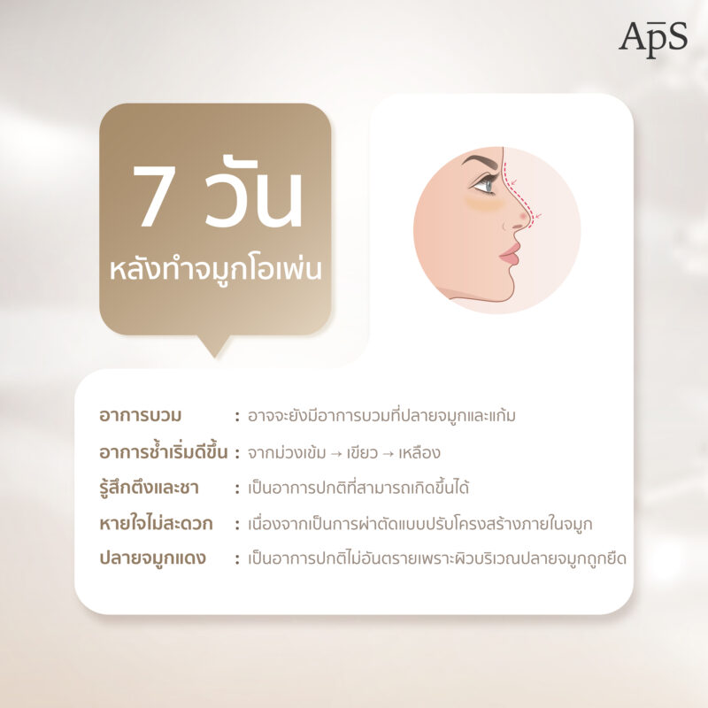 อาการหลังทำศัลยกรรมเสริมจมูกโอเพ่น เป็นอย่างไร อันตรายไหม 5 7 วันหลังการเสริมจมูกโอเพ่น