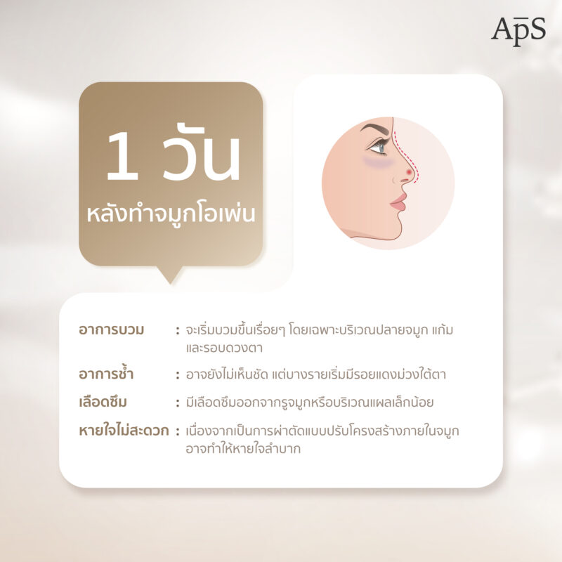 อาการหลังทำศัลยกรรมเสริมจมูกโอเพ่น เป็นอย่างไร อันตรายไหม 4 1 วันหลังทำจมูกโอเพ่น