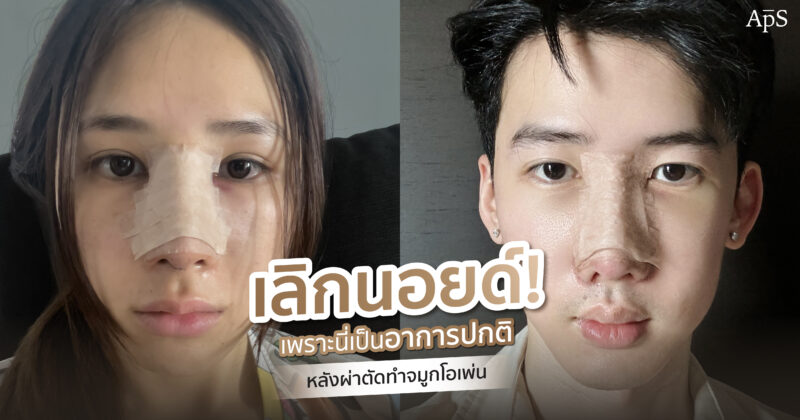 อาการหลังทำศัลยกรรมเสริมจมูกโอเพ่น