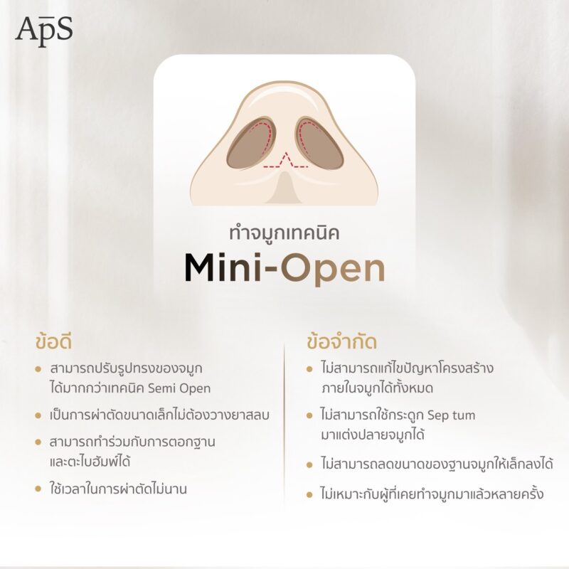 ทำจมูกเทคนิค Mini Open ทางเลือกใหม่ของการศัลยกรรมจมูกที่แม่นยำและไม่อันตราย 2 ข้อดี - ข้อเสียของการทำจมูกเทคนิค Mini Open