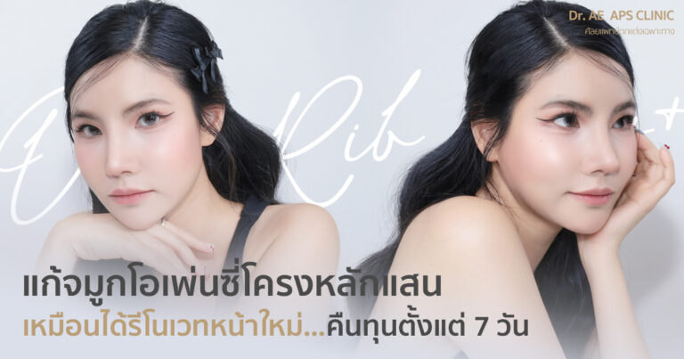 แก้จมูกที่เสริมมานานทีเดียวเหมือนรีโนเวทหน้าด้วยเทคนิค Open Rib Plus+