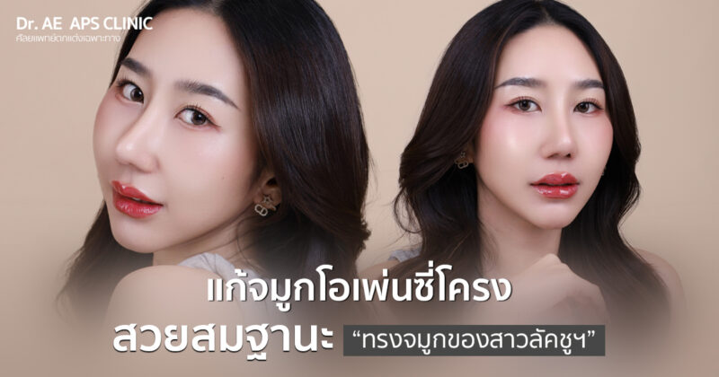 ทำจมูกมาแล้วแต่ไม่ชอบ แก้จมูกโอเพ่นซี่โครง Open Rib Plus+