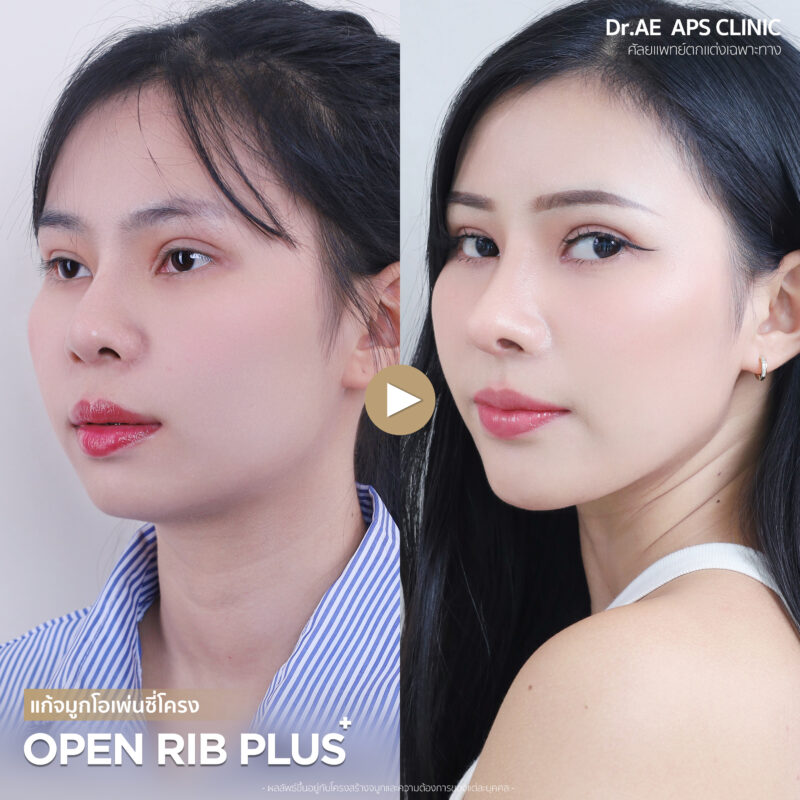 รีวิวเสริมจมูกโอเพ่นซี่โครง คุณแกง