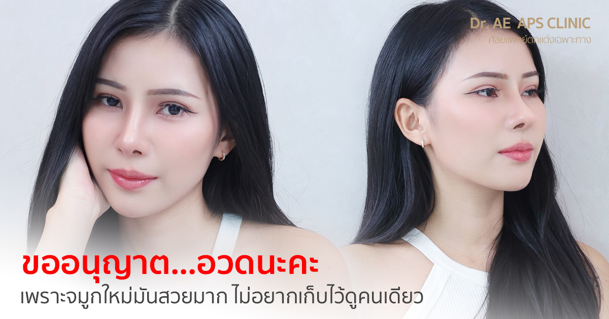 รีวิวเสริมจมูกโอเพ่นซี่โครง คุณแกง