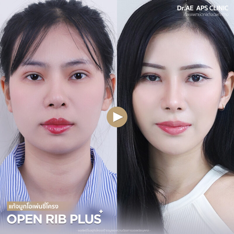 รีวิวเสริมจมูกโอเพ่นซี่โครง คุณแกง