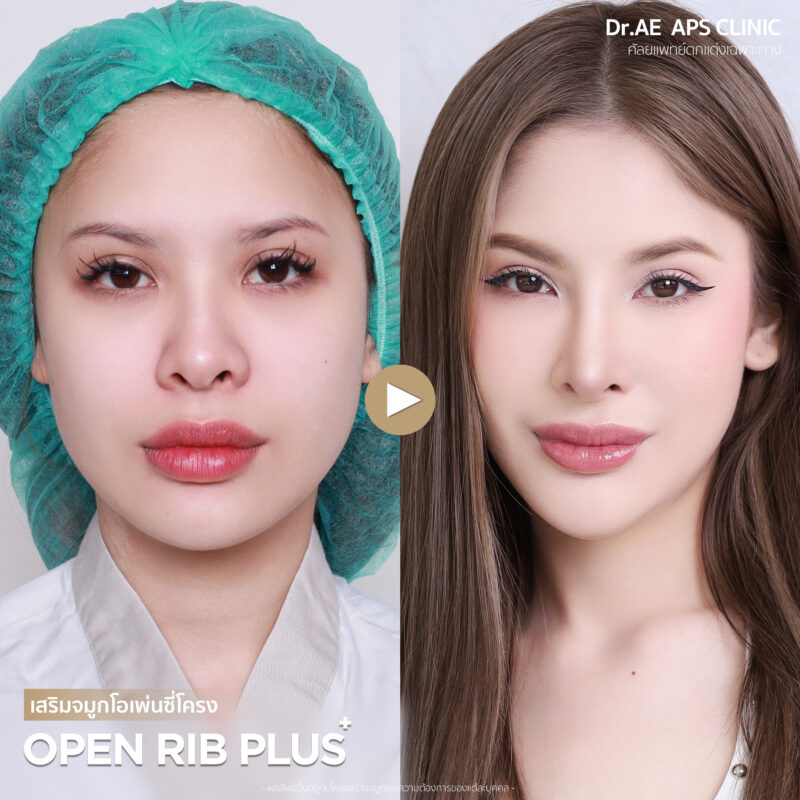 เปลี่ยนทรงจมูกใหม่ให้ดูสวยละมุนขึ้น คุณมิวสิก