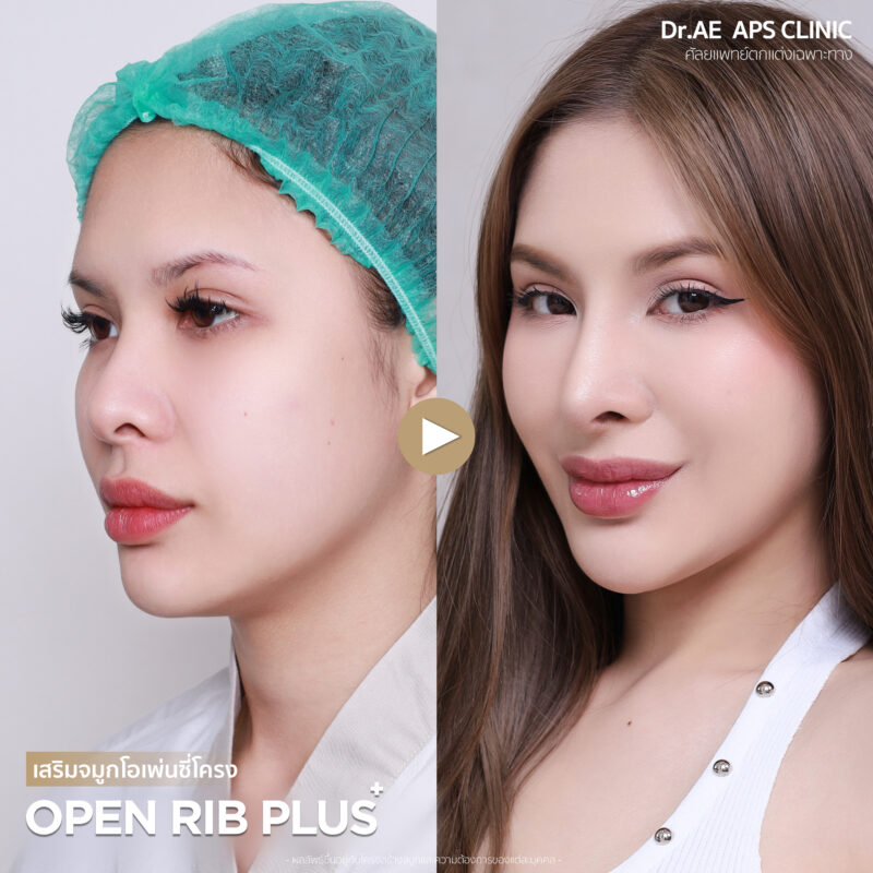 เปลี่ยนทรงจมูกใหม่ให้ดูสวยละมุนขึ้น คุณมิวสิก