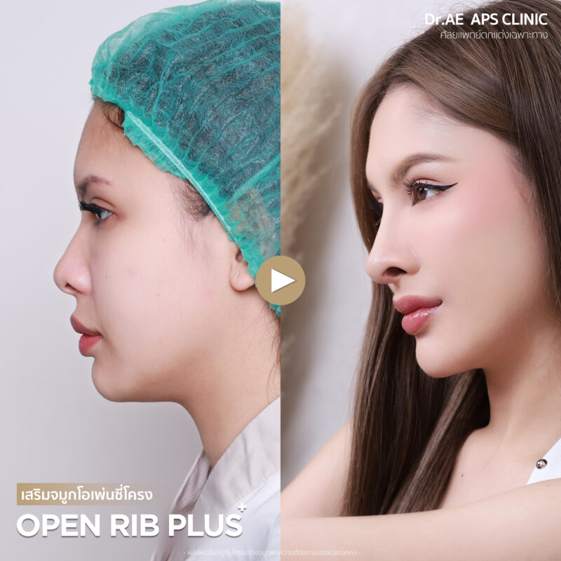 เปลี่ยนทรงจมูกใหม่ให้ดูสวยละมุนขึ้น คุณมิวสิก