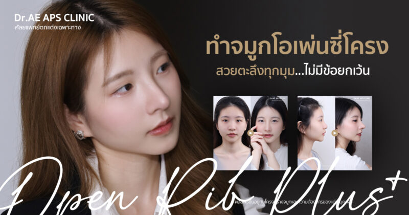 คุณมายด์ รีวิวเสริมจมูก Open Rib Plus+