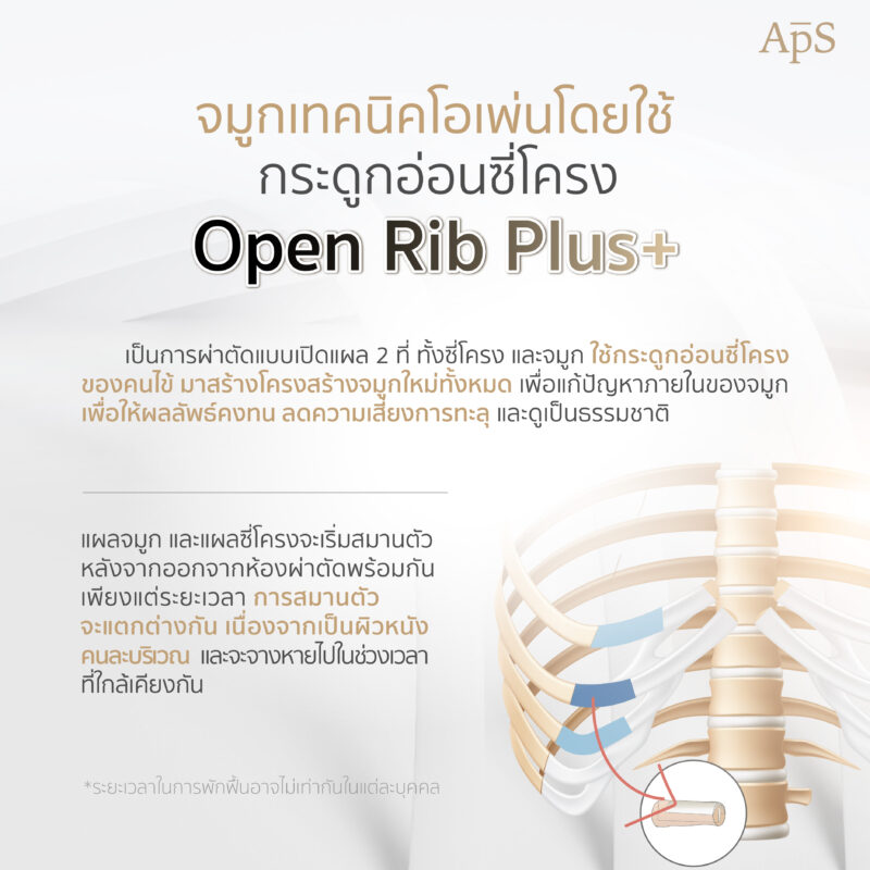 ทำจมูกโอเพ่นซี่โครงพักฟื้นนานไหม? 2 การทำจมูกเทคนิคโอเพ่นโดยใช้กระดูกอ่อนซี่โครง