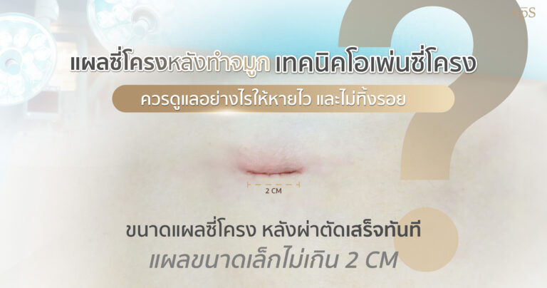แผลซี่โครงจากการทำจมูกโอเพ่นซี่โครง