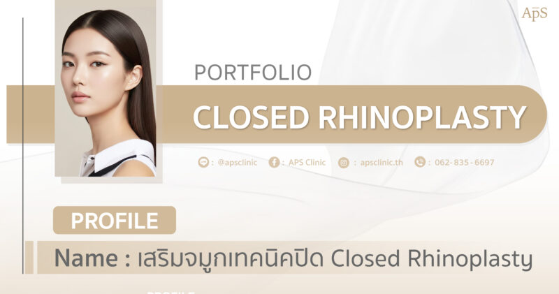 ทำจมูกเทคนิคปิดเหมาะกับใคร