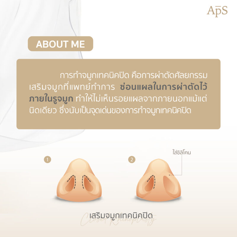 ทำความรู้จักการทำจมูกเทคนิคปิด (Closed Rhinoplasty)