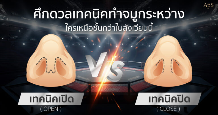 เลือกทำจมูกแบบ Close หรือแบบ Open เทคนิคไหนดีกว่ากัน?