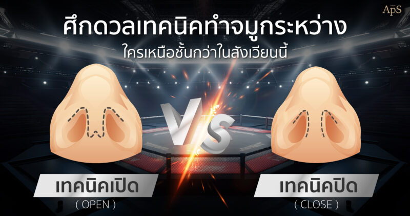 เลือกทำจมูกแบบ Close หรือแบบ Open เทคนิคไหนดีกว่ากัน?