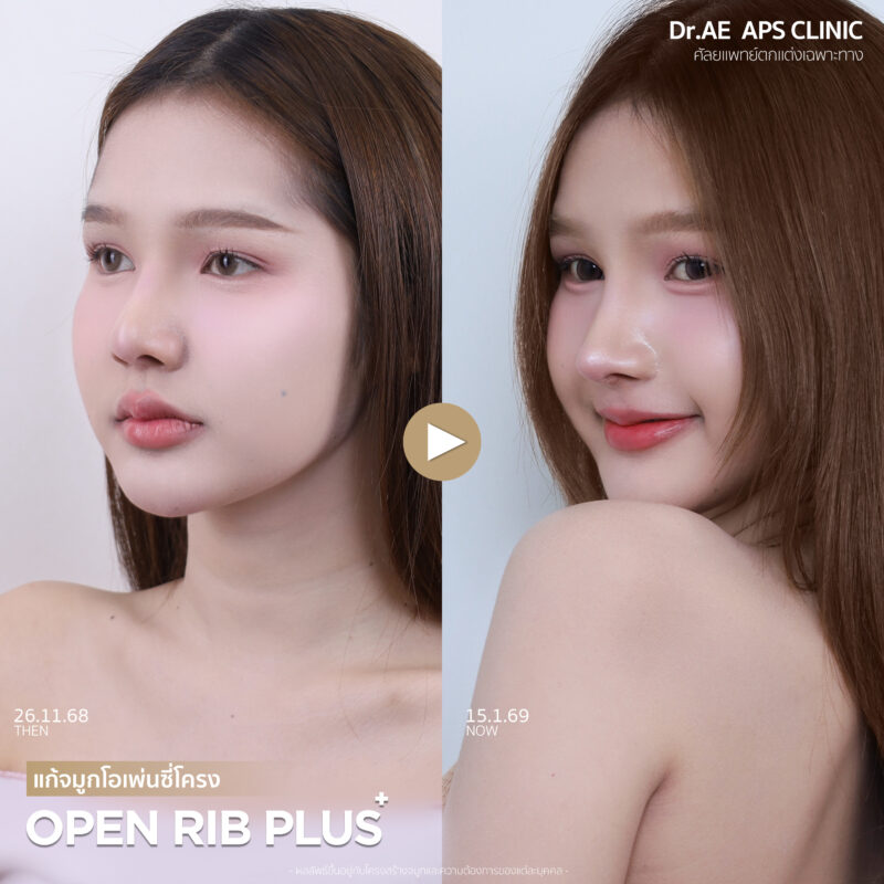 รีวิวแก้จมูกร็อกกี้ 1 เดือน ด้วยเทคนิค Open Rib Plus+ ที่ APS Clinic โดยร็อกกี้