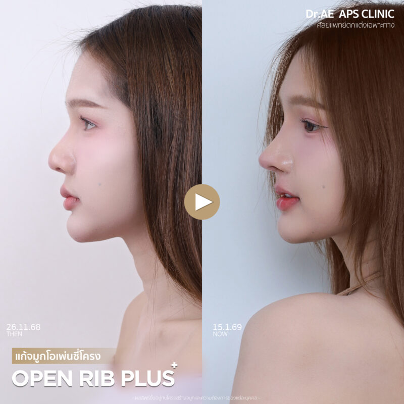รีวิวแก้จมูกครบ 1 เดือน ด้วยเทคนิค Open Rib Plus+ ที่ APS Clinic โดยร็อกกี้