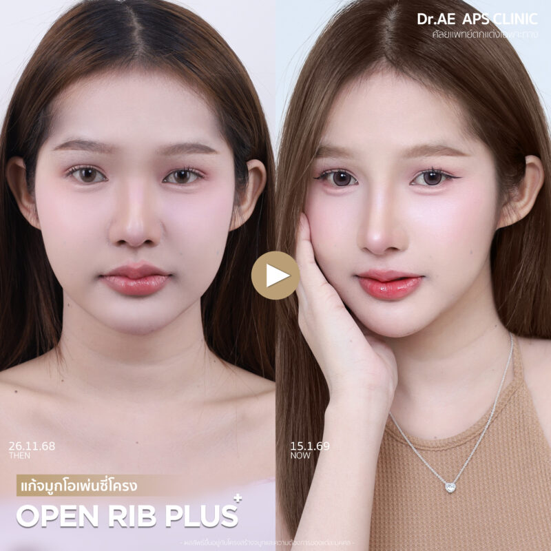 รีวิวแก้จมูกร็อกกี้ 1 เดือน ด้วยเทคนิค Open Rib Plus+ ที่ APS Clinic โดยร็อกกี้