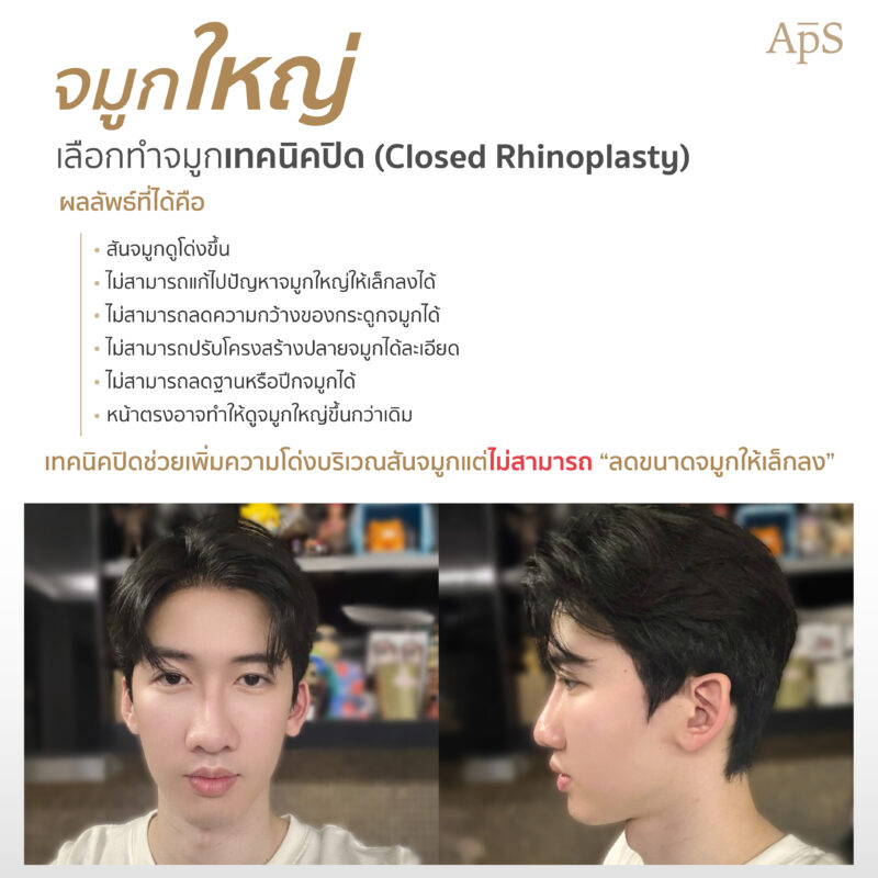 เสริมจมูกแบบปิด (Closed Rhinoplasty)