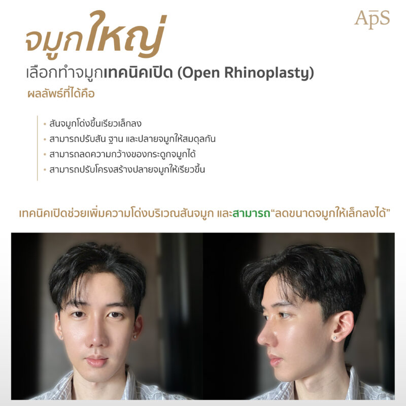 เสริมจมูกแบบโอเพ่น (Open Rhinoplasty)