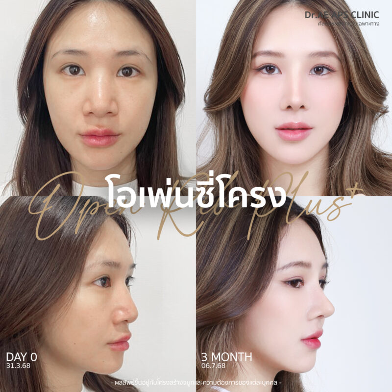 จมูกใหญ่