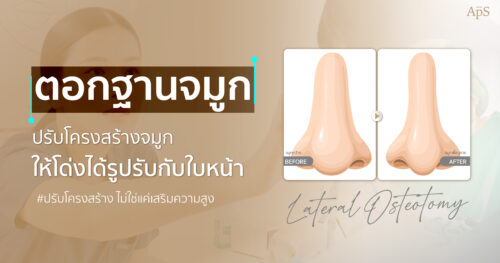 ตอกฐานจมูก