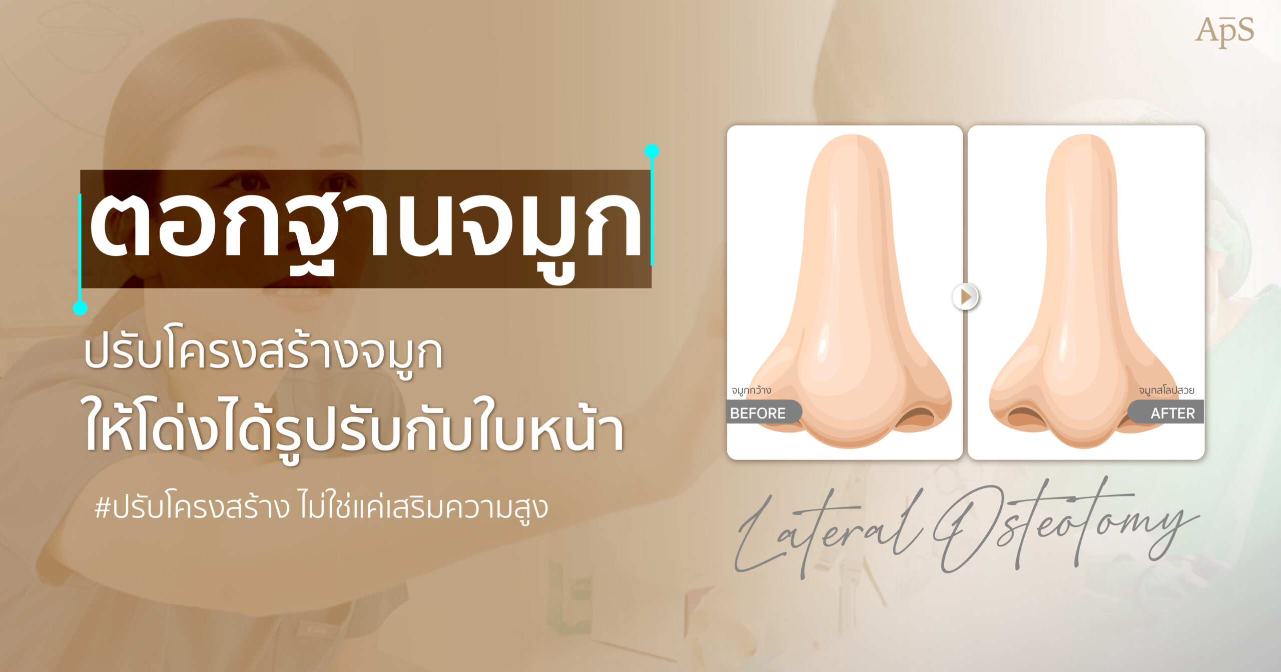 ตอกฐานจมูก