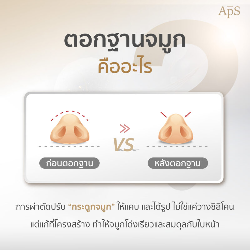 ตอกฐานจมูก ปรับโครงสร้างจมูกให้โด่งได้รูปรับกับใบหน้า 1 ตอกฐานจมูก คืออะไร